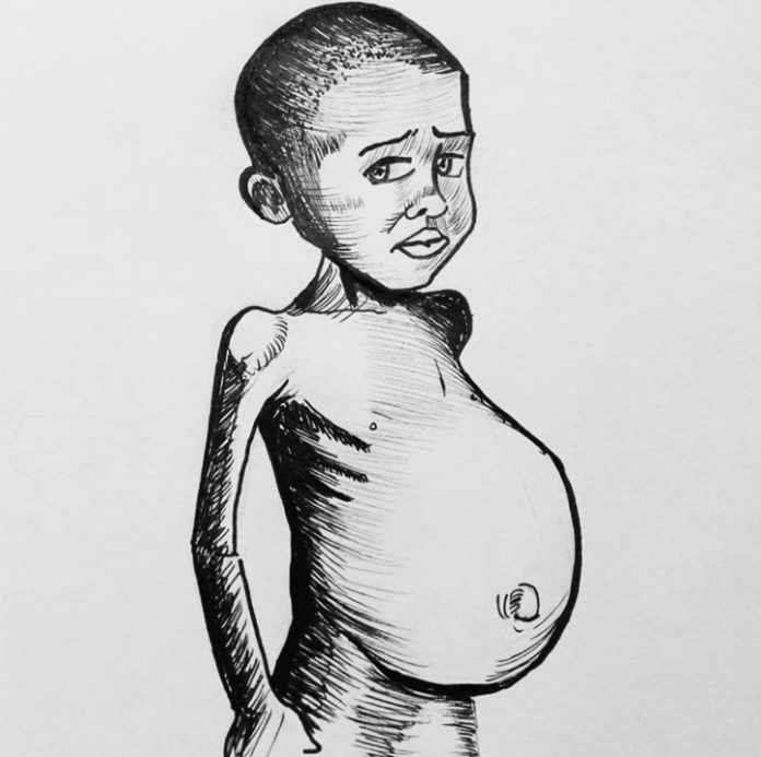 Kwashiorkor Symptoms Treatment