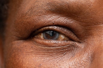 Common Eye Diseases in Nigeria