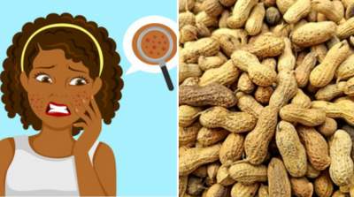 Does groundnut cause pimples?