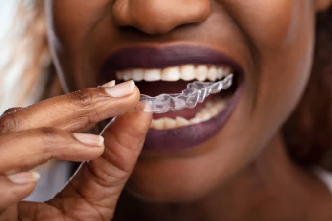 Invisalign Cost in Nigeria