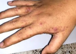 Scabies Infection in Nigeria