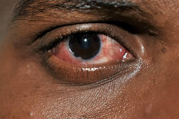 Apollo Eye Disease