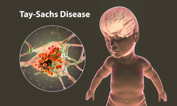 Tay-Sachs Disease common inherited diseases in Nigeria