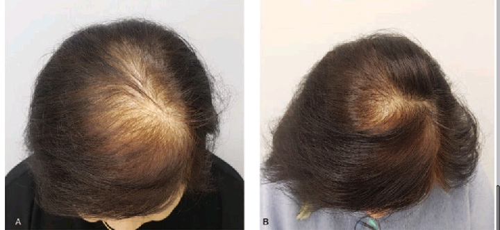 Before and after Red Light Therapy for Hair Growth